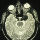 2024-05-16-Live-Lecture-Neuroimaging-for-Challenging-Cases-Martin-ten-Hove-product
