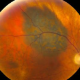 2024-12-19-Live-Lecture-Choroidal-Melanocytic-Tumors-Arun-Singh-product