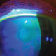 2025-06-19-Live-Lecture-Approach-to-the-Tearing-Patient-Lisa-Jagan-product
